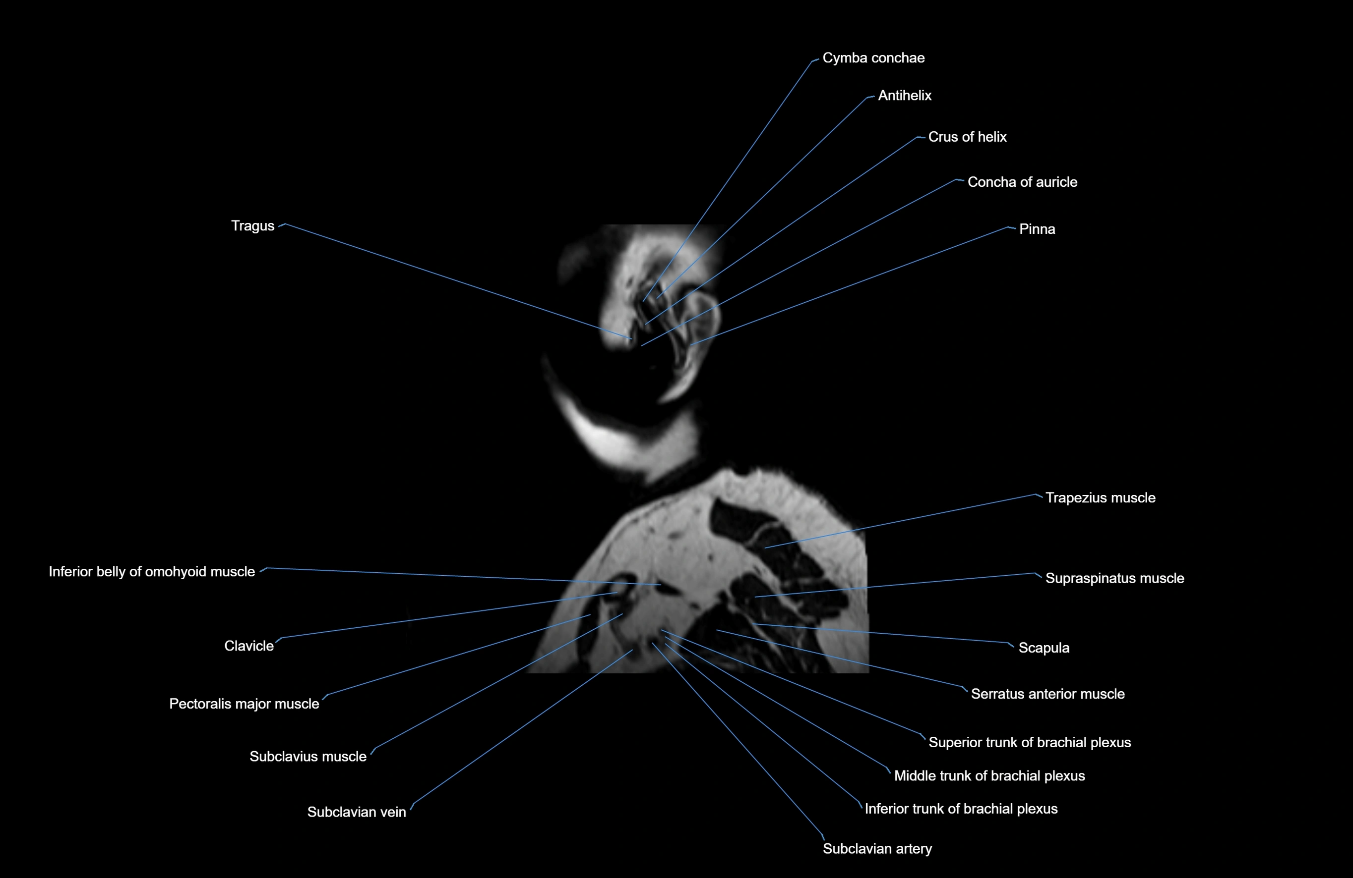 Neck MRI sagittal cross sectional anatomy 3D 1mm 3T radiology  image-img-00001-00044.webp